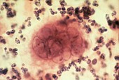 LM of cervical smear infected with Herpes simplex