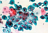 LM of cervical smear: Chlamydia infection