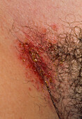 Infected herpes simplex lesions on a woman's groin