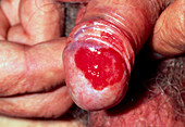 Close-up of penis affected by candidiasis (thrush)