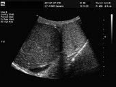 Inflamed testis,ultrasound