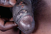 Genital herpes ulcers