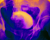 False-colour IVU showing enlarged prostate