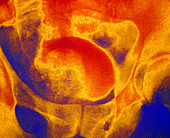 False-colour IVU showing enlarged prostate
