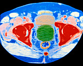 Col CT scan of enlarged prostate gland wi