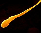 Coloured SEM showing deformed sperm (double body)