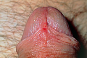 Close-up of tip of man's penis with torn frenulum