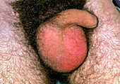 Swollen testis with malignant teratoma (cancer)
