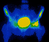 Coloured gamma scan of metastatic prostate cancer