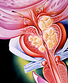Artwork of a benign prostatic hyperplasia