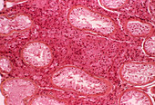 Abnormal testicle,light micrograph