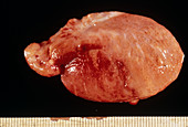 Swollen testicle