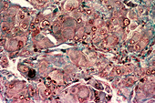 Benign testicle tumour,light micrograph
