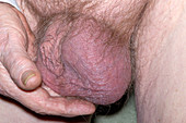 Inflamed testicles in epididymo-orchitis