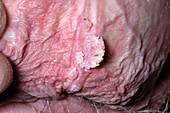 Genital warts