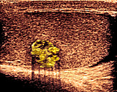 Testicular cancer,ultrasound scan