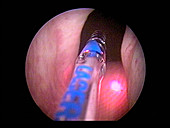 Laser prostate surgery