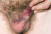 Bruised penis and scrotum
