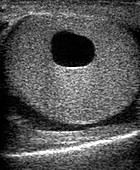 Testicular cyst,ultrasound scan