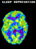 Colour PET scan of brain during sleep deprivation