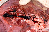 Lung blood clot,post-mortem