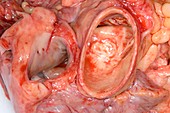 Aorta and vena cava,post-mortem