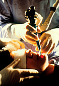 Surgeon removing facial wrinkles using a laser