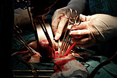 Hysterectomy surgery