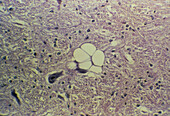 LM of mad cow brain infected with BSE
