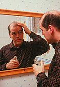 Balding man applies a lotion to his scalp