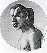 Joseph Merrick,The Elephant Man