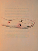 Drawing of cowpox pustules on a hand,Jenner