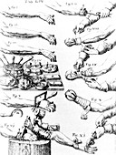 Historical artwork of 17th century arm surgery