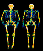 Bone densitometry scans of the skeletons of twins
