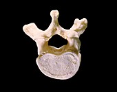 Human first lumbar vertebra (L1)