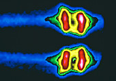 False-colour scintigram of normal human knees