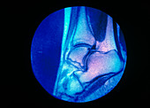 False-colour X-ray of ankle showing Achilles tendn