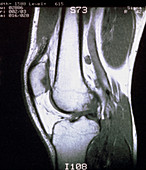 MRI scan of sagittal section through knee joint