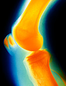 Coloured X-ray image of a normal knee-joint
