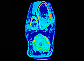 Coloured CT scan of a normal knee joint