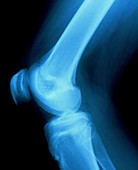 X-ray of normal knee joint of 15-year-old girl