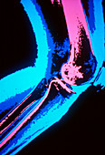 Coloured X-ray of human knee joint in profile