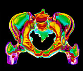 3-D CT scan of bones of a normal adult pelvis