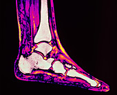 Coloured MRI scan of ankle bones in the human foot