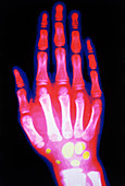 Coloured X-ray of a 12 year old child's hand