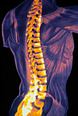 Coloured 3-D CT scan of the human spine