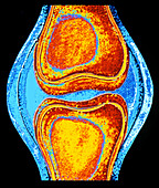 Computer artwork of a human knee joint
