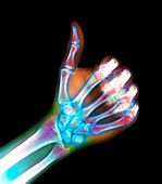 Coloured X-ray of a hand giving a thumb-up sign