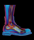 Coloured X-ray of man's foot in a Doc Marten boot