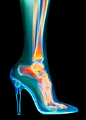 Woman's foot in high-heel shoe,X-ray